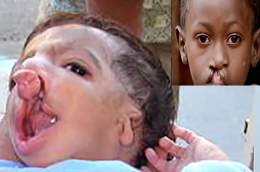 Child with cleft palate